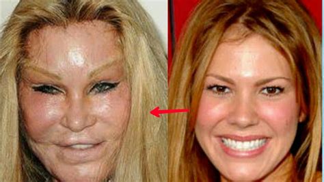 bad plastic surgery before and after pictures